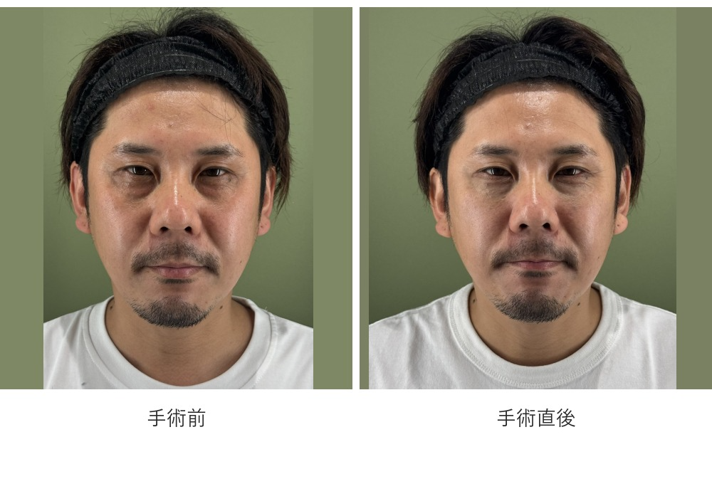 裏ハムラ_症例画像